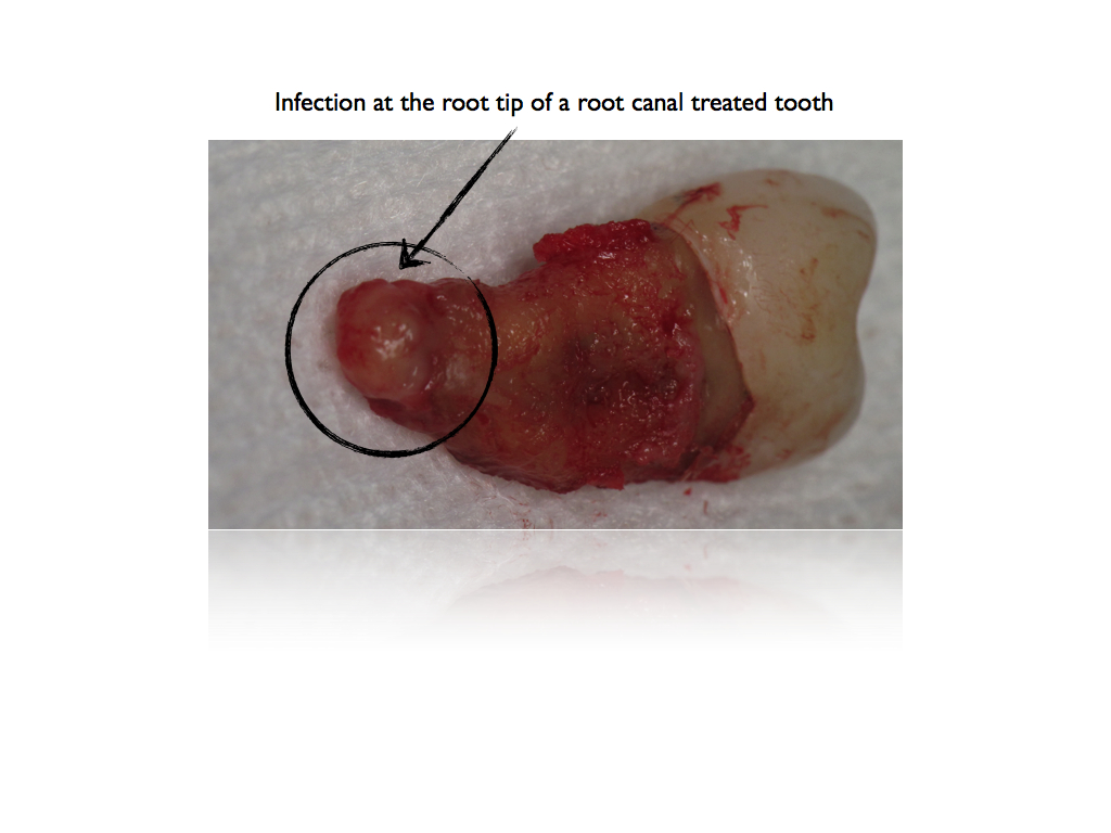 Infected-Root-Canals.001