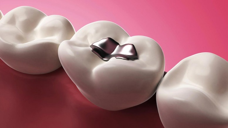 Mother’s dental amalgams increase child’s exposure to mercury – before and after birth